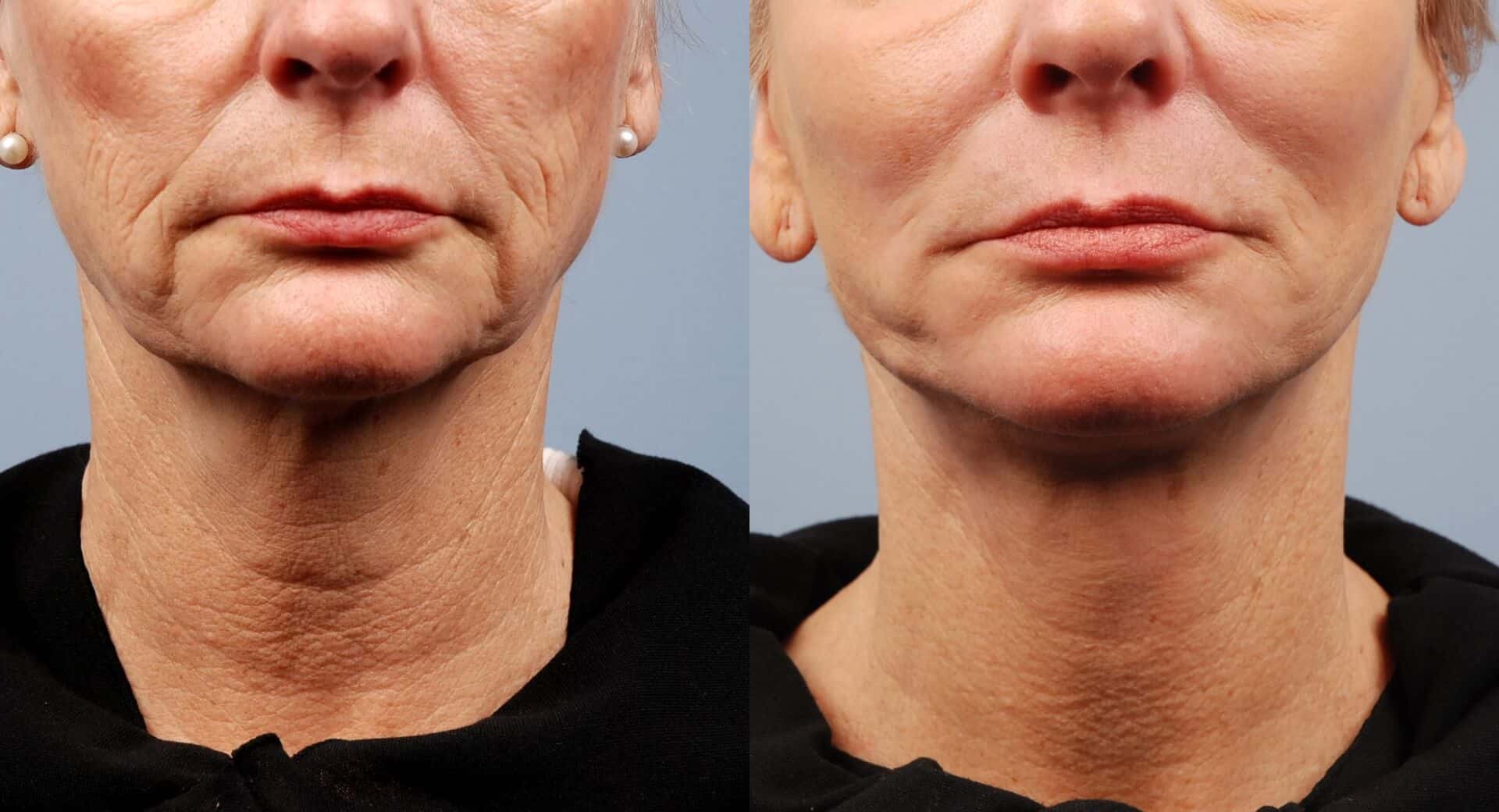 Morpheus8 radiofrequency microneedling lifting treatment