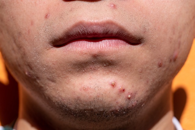 Treatments for enlarged facial pores