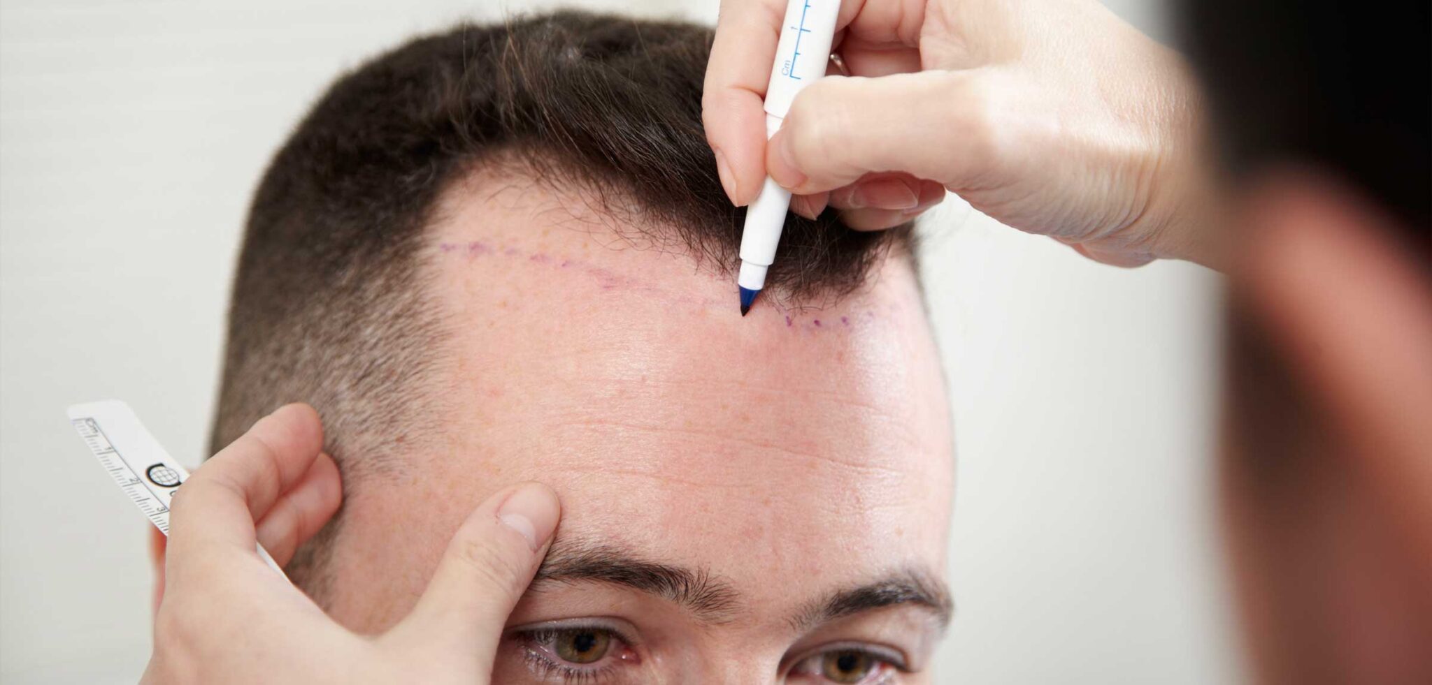 FUE hair transplant technique