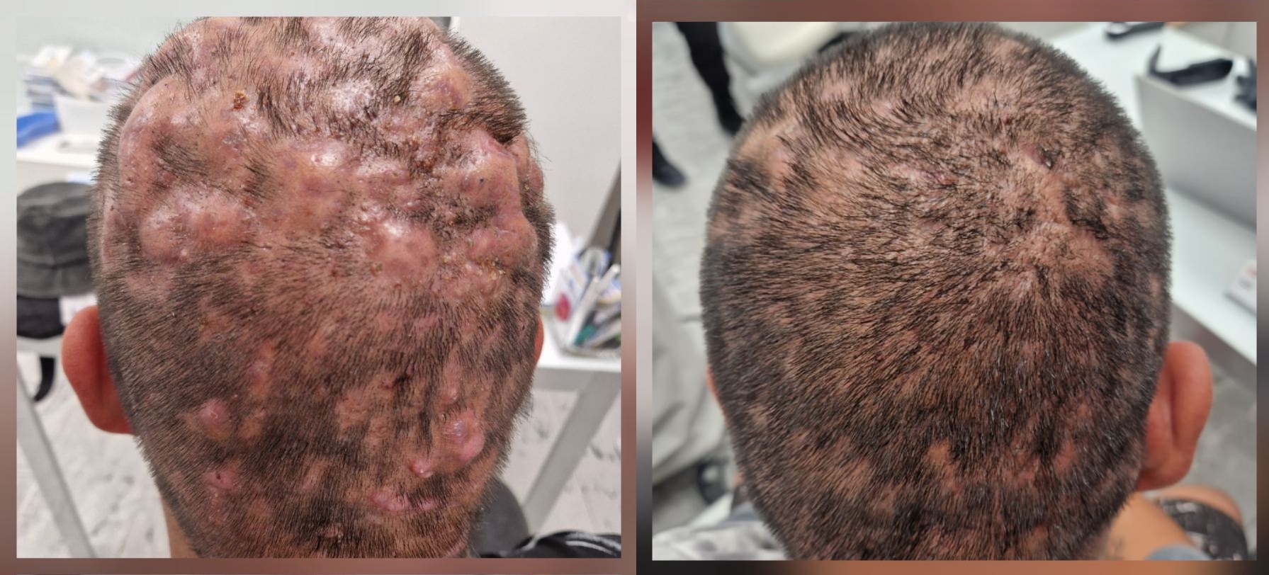 Dissecting cellulitis of the scalp causing hair loss and scarring