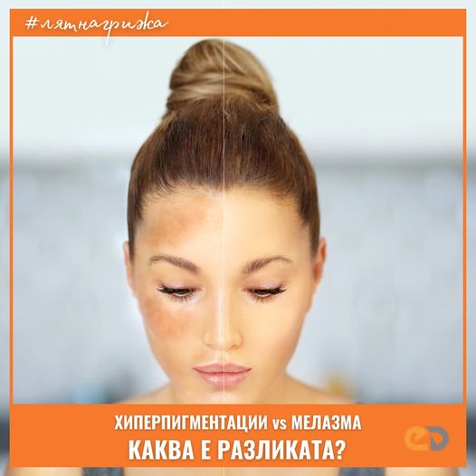 Difference between hyperpigmentation and melasma on the skin