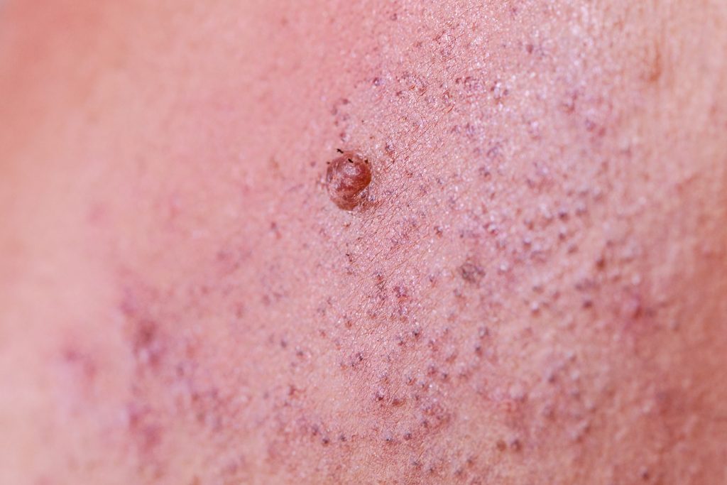 Фоликулит – откриване и успешно лекуване