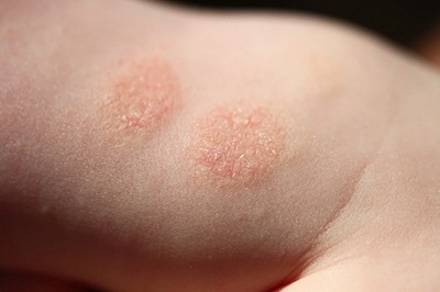 Себореен дерматит при деца