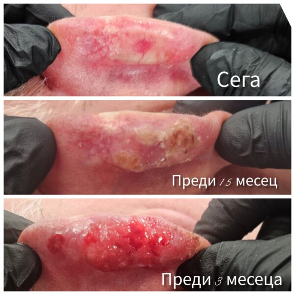 Dermatosurgery for basal cell carcinoma of the ear — clinical case