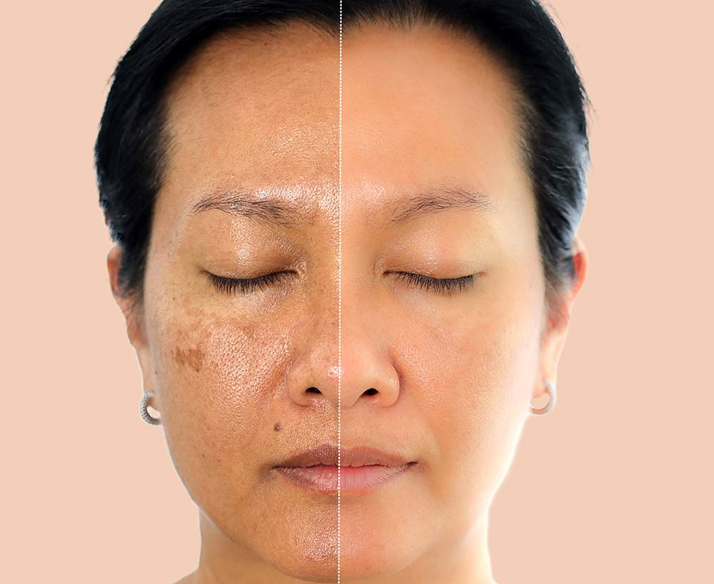 Melanoderma, chloasma and melasma pigmentation on facial skin