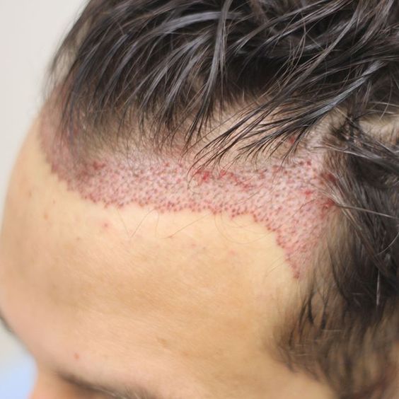 Какво да знаем за трансплантацията на коса