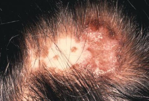 Дискоиден лупус еритематозус