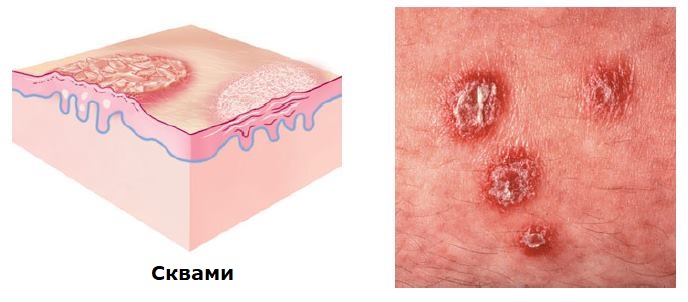 Treatment of skin scales on the scalp and face