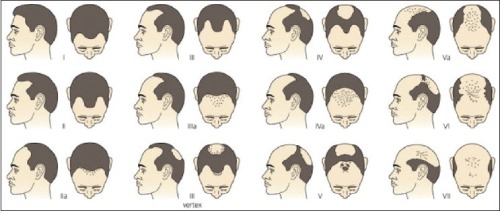 Косопад – видове