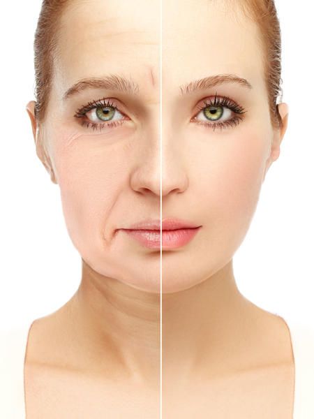 Non-surgical facial rejuvenation result