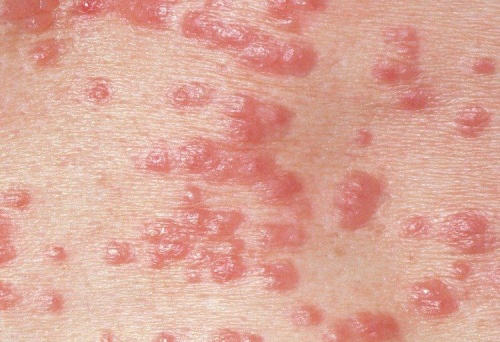 Какво представлява микоза?