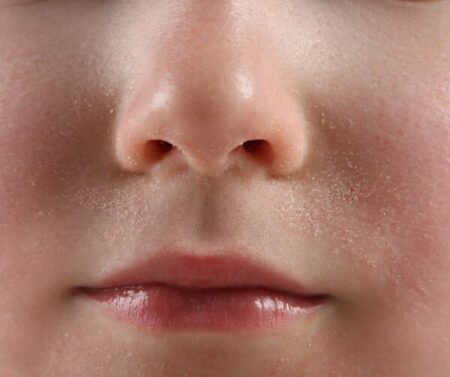 Какво представлява и как се развива себореен дерматит