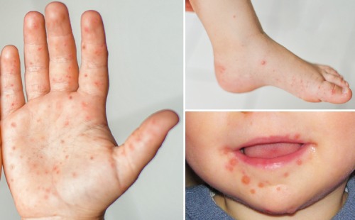 Болест ръка-крак-уста (Hand-Foot-Mouth disease)