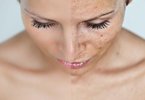 Хиперпигментация – тъмните петна по кожата ни