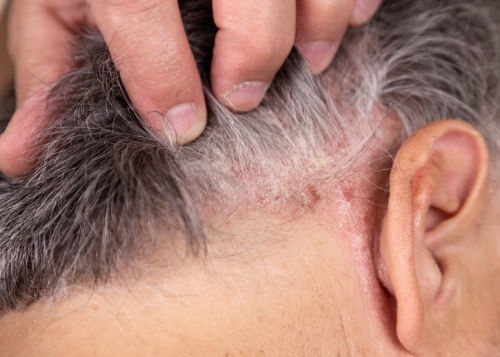 Какво представлява псориазис и как се проявява