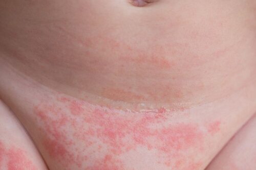 Какви са причините и симптомите за поява на памперс дерматит