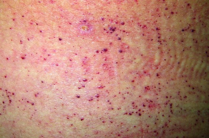 Ангиокератом и видове в човешкото тяло