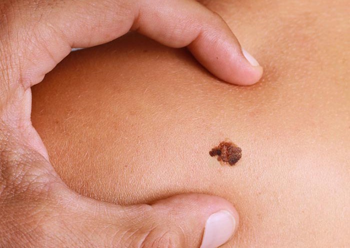 Malignant melanoma of the skin and its treatment